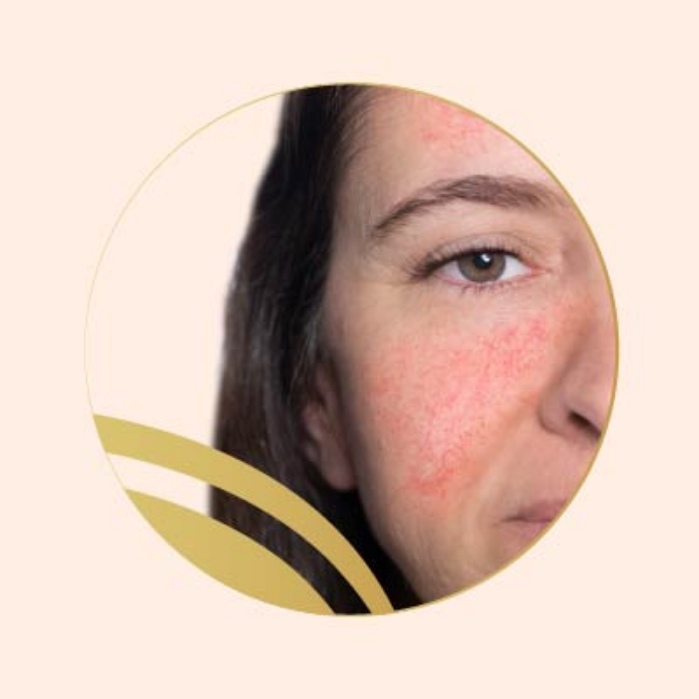 Picture for category Rosacea Skin
