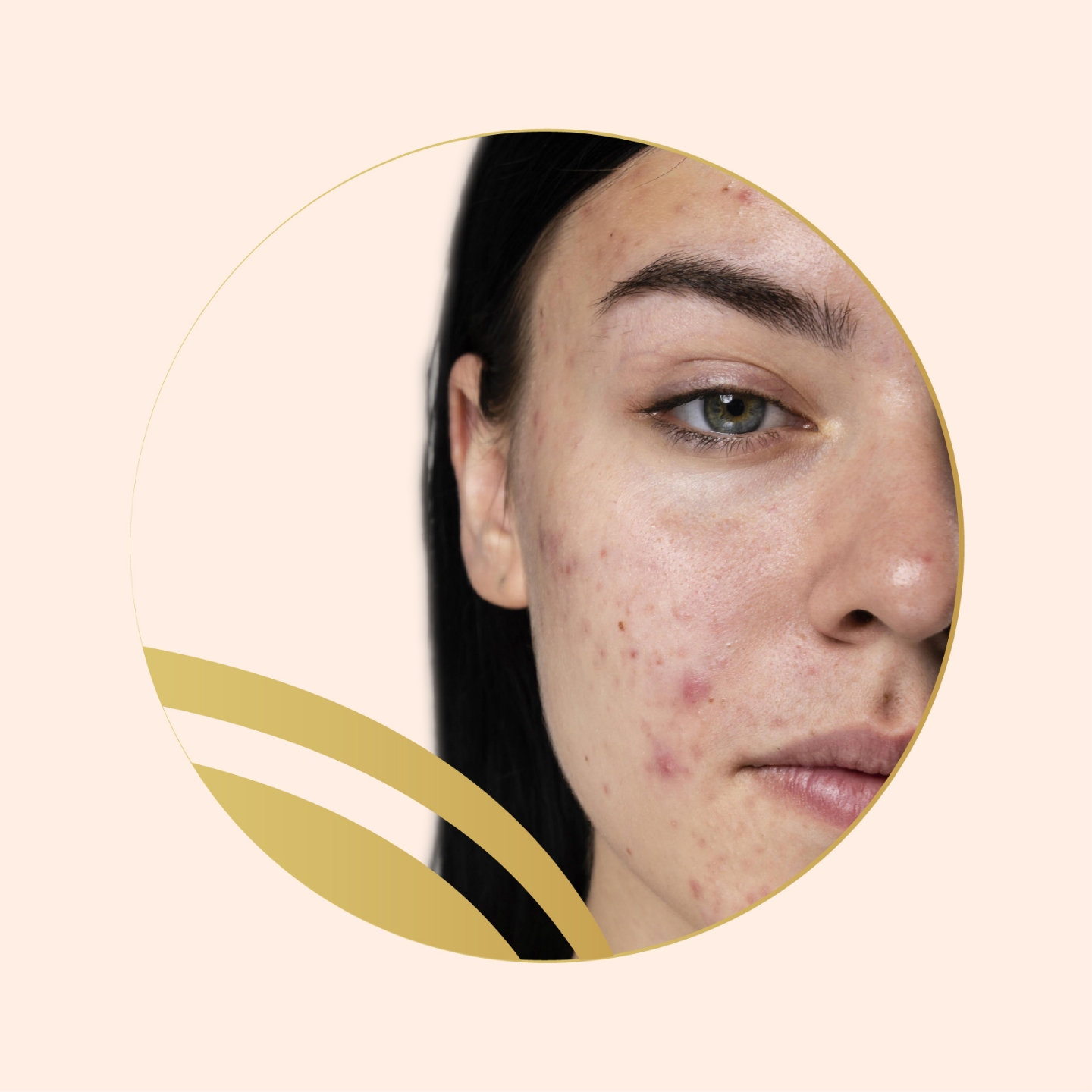 Picture for category Acne And pores